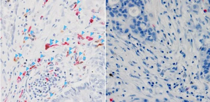 Human tumor samples show impact of immune protein C3