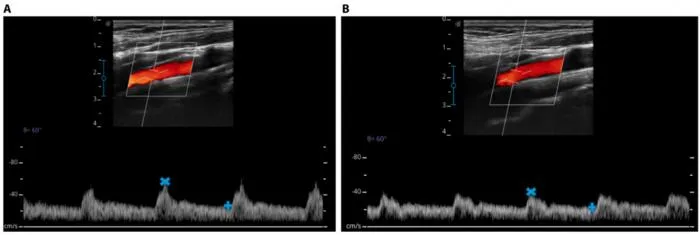Hemodynamic characteristics of the internal carotid artery (ICA) in a 24-year-old male participant at baseline and after 12 h of head-down tilt bed rest (HDT BR), derived from ultrasound Doppler imaging.