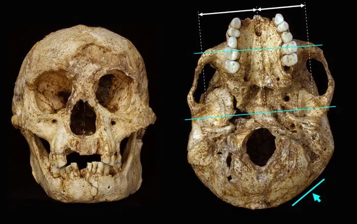 Cranial deformation in H. floresiensis