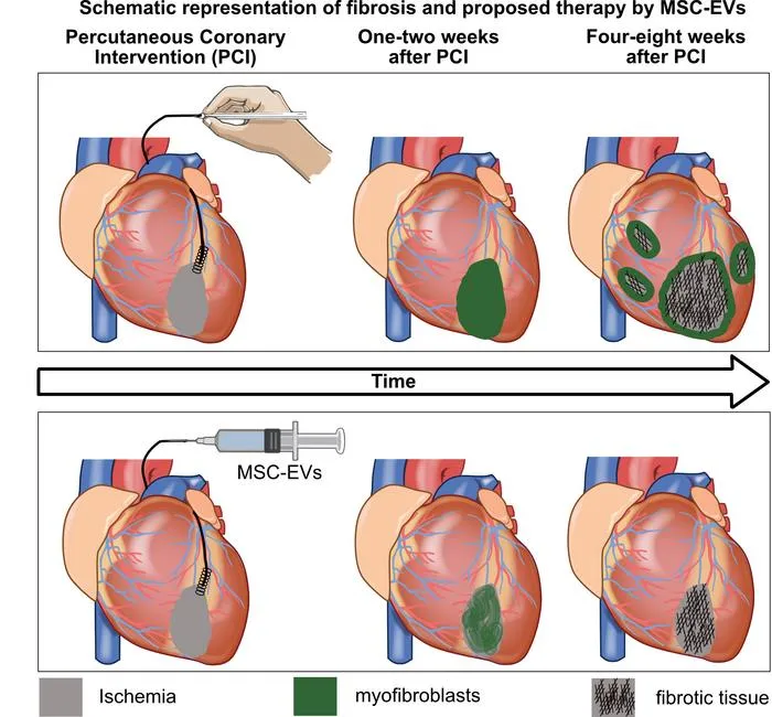 Schematic representation of fibrosis and proposed therapy by MSC-EVs