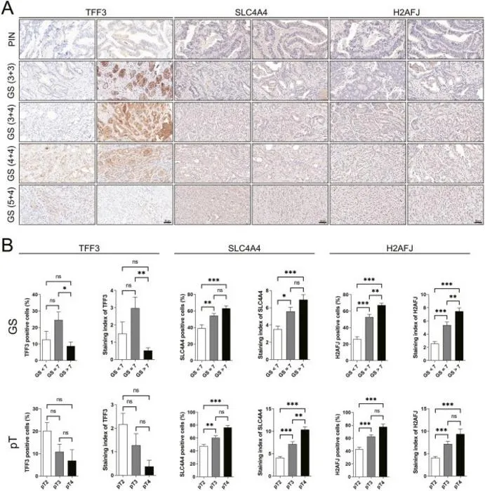 The expression levels of H2AFJ, SLC4A4, and TFF3 proteins in prostate tissues with PIN and varying GSs.