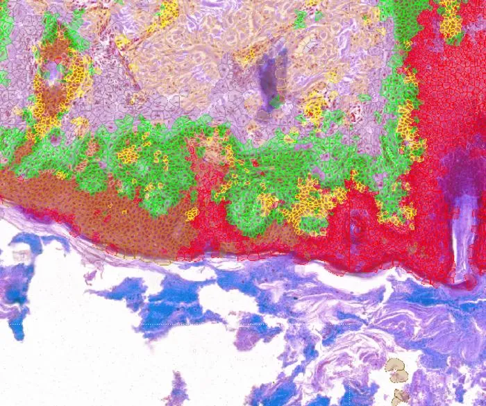 AI guided cancer cell analysis