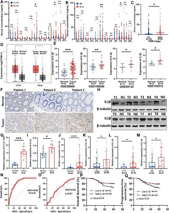 IL-1β is up-regulated in colorectal cancer (CRC) and associated with clinicopathological features.