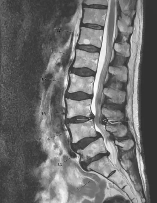 Newly Discovered Stem Cell Reveals Potential Drug Target for Spinal Stenosis