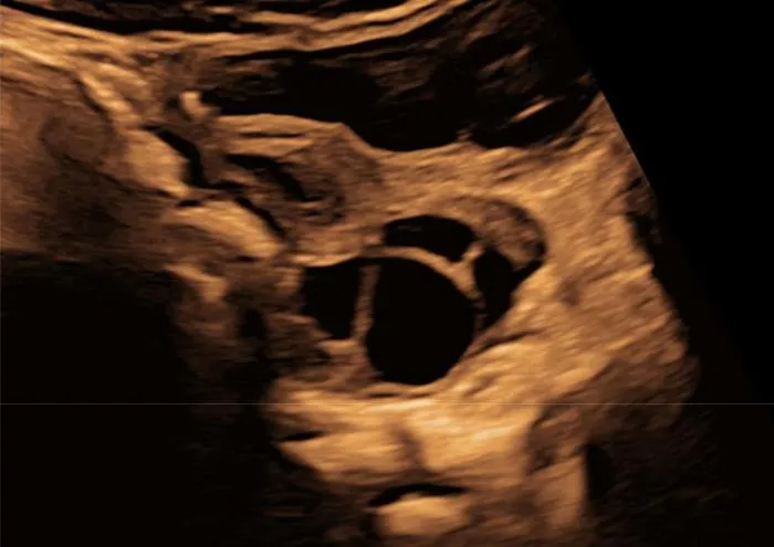 Paracetamol use during pregnancy is linked to changed reproductive development in daughters