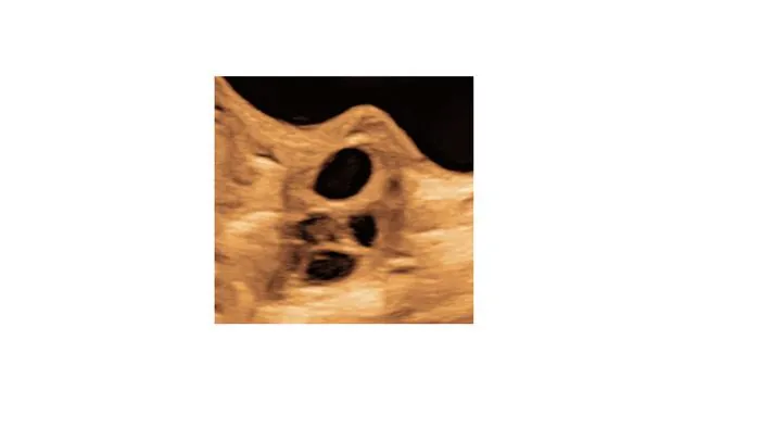 Paracetamol use during pregnancy is linked to changed reproductive development in daughters