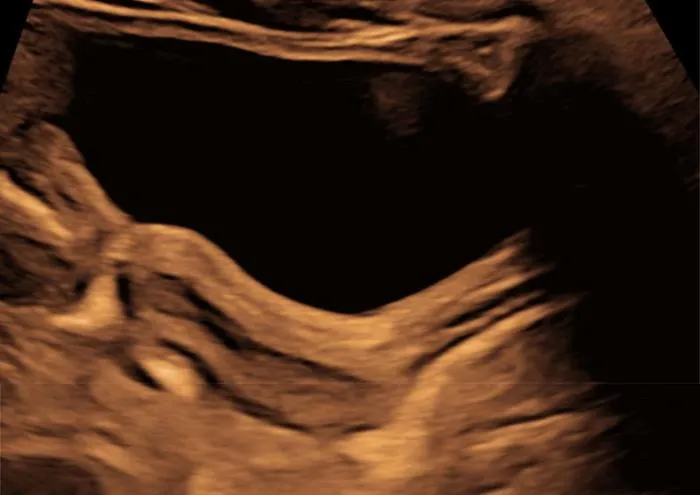 Paracetamol use during pregnancy is linked to changed reproductive development in daughters
