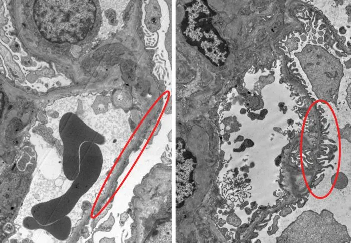Healthy versus damaged podocytes