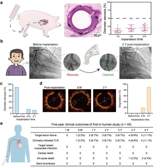 Five-year first-in-human clinical outcomes of the PLA-coated biodegradable iron stent