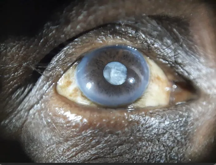 Smartphones could be used to screen for cataracts and other eye problems