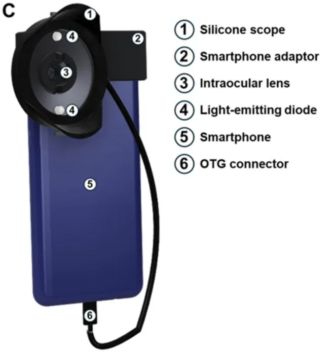 Smartphones could be used to screen for cataracts and other eye problems