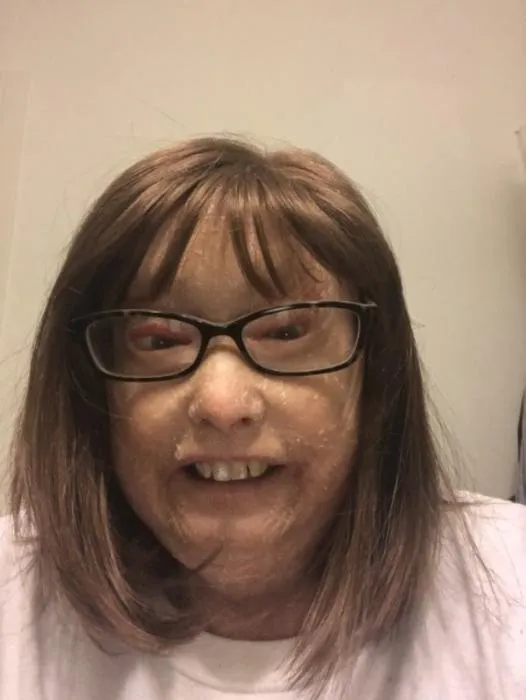 Laura Hogan, 69, lives with with the rare skin condition lamellar ichthyosis