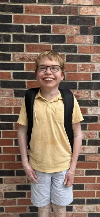 Mason Roach of Ottawa, Illinois, a 13-year-old living with epidermolytic ichthyosis