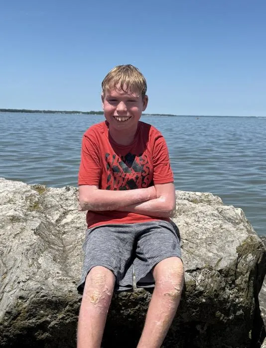 Mason Roach of Ottawa, Illinois, a 13-year-old living with epidermolytic ichthyosis