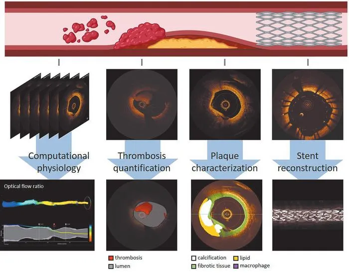 Figure 4Open multimedia modalSchematic of artificial intelligence-driven computational methods in intravascular imaging.
