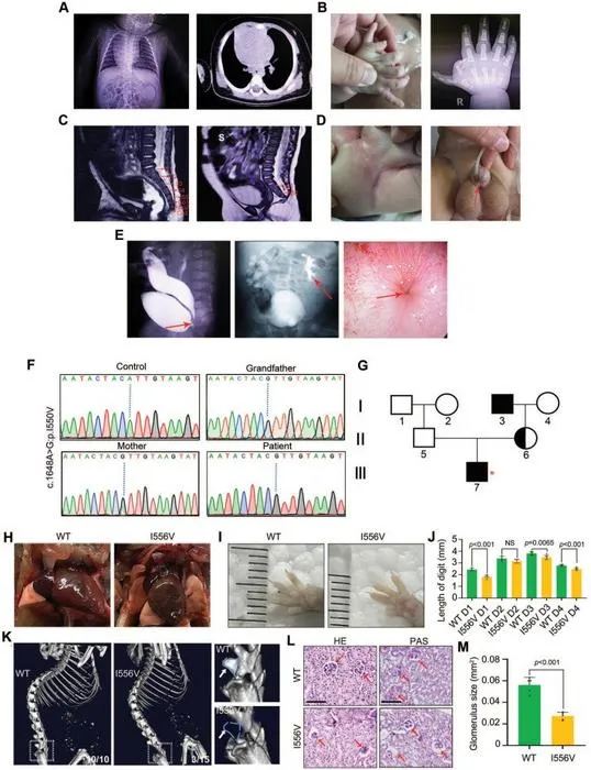A novel MED14 variant is associated with VACTERL association in a human patient and in a mouse model