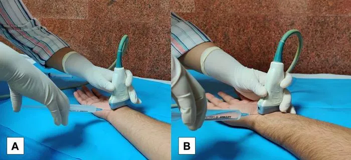 Photographs of needle insertion for the ultrasound-guided hydrodissection procedure